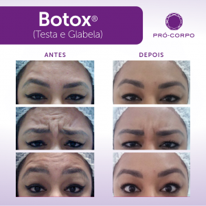 Botox ®: Fotos Antes e Depois